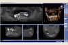 Beispiel 6: 3D Röntgen mit virtueller Implantatplanung