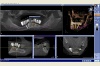 Beispiel 5: 3D Röntgen mit virtueller Implantatplanung