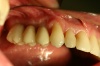 BRÜCKE - Fall 1: Spiegelaufnahme mit eingesetzten Zähnen von der Seite