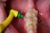 Anwendung einer Zahnwischenraumbürste