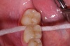 Anwendung von Interdentalfloss zur Pflege der Zahnzwischenräume